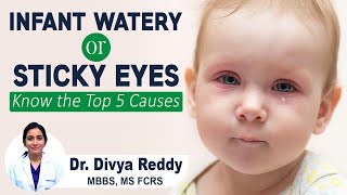 INFANT WATERY OR STICKY EYES  Baby Watering Eyes Causes and Treatments  Best Vision Eye Hospital [upl. by Gwenny]