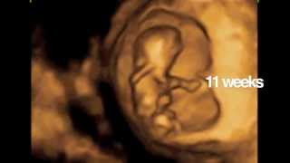 Dancing Babies 4D Ultrasound of Babies Saved [upl. by Anilra]