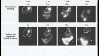 Vaciamiento gástrico e hiperglucemia postprandial  P1 [upl. by Susejedesoj]