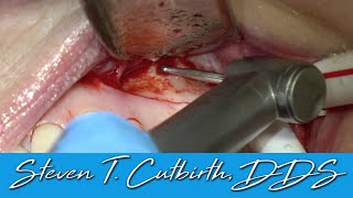 Maxillary 1st Molar Apicoectomy  Dental Minute with Steven T Cutbirth DDS [upl. by Anorahs]