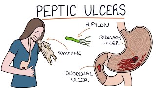 Symptoms of Gastric and Duodenal Ulcer [upl. by Hearn]