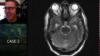 Isolation tutorial Neuroradiology with Frank Gaillard [upl. by Nolos102]