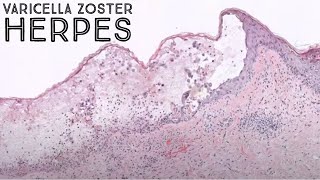 Shingles under the microscope Varicella Zoster Herpes virus Chickenpox VZV pathology dermatology [upl. by Florian]