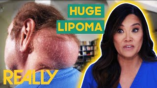 Dr Lee Removes A Massive Lipoma From A Mans Neck  Dr Pimple Popper [upl. by Mascia]