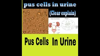 Why Pus Cells Comes In Urine  CuasesOfPusCells Causes Symptoms Treatment [upl. by Burton846]