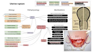 Uterine rupture mechanism of disease [upl. by Diskson]