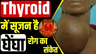 Goiter Causes Diagnosis Symptoms and Treatment  क्या है घेंघा रोग  Dr Kanchan Singh। [upl. by Alinna]