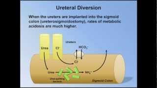 Normal Anion Gap Metabolic Acidosis ABG Interpretation  Lesson 9 [upl. by Ennyletak]