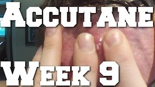 Lifting HEAVY Side Effects amp Cysts on Accutane Week 9 [upl. by Tergram]