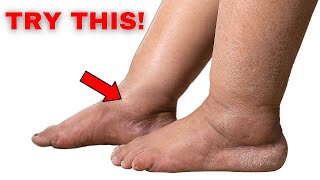 1 Exercise To Eliminate Swelling in Feet and Legs  Metabolic Solutions [upl. by Aniara133]