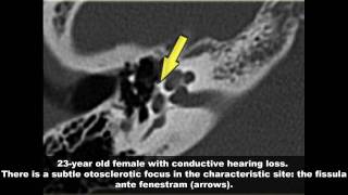 Temporal Bone Radiology Case Review [upl. by Demaria]