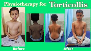 Torticollis Physiotherapy treatmentWry Neck Exercises Torticollis stretching exercises [upl. by Abla]