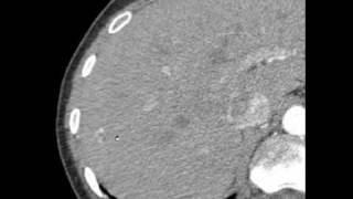 CT interpretation  hemangioma liver [upl. by Notwen]