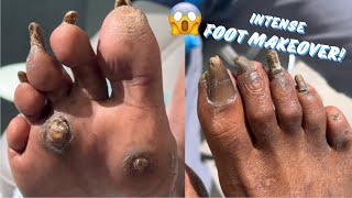 INTENSE FOOT MAKEOVER  PART 1 [upl. by Assiluy]