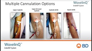 BD WavelinQ™ EndoAVF Cannulation Inservice Training [upl. by Tami]