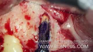 Endodontic Microsurgery [upl. by Yruj]