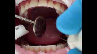 ASMR  Dental scaling [upl. by Nur]