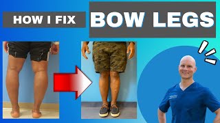 The ONLY way to Fix Bow Legs  Get the Facts [upl. by Akimal763]