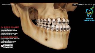 Jaw Advancement Surgery Explained Bilateral Sagittal Split Osteotomy [upl. by Aisital]