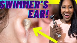 SWIMMER’S EAR Otitis Externa Treatments Causes amp Prevention A Doctor Explains [upl. by Hotze]