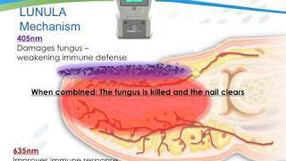 The Science Behind The Lunula Laser For Toenail Fungus Onychomycosis [upl. by Analem960]