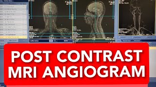Contrast Enhanced MRA Brain and Neck Vessels protocol positioning and planning [upl. by Chas]