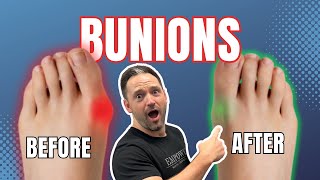 How To Fix Bunions  3 Easy Steps [upl. by Nnylatsyrk]