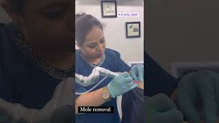 Mole Removal  DrMona Swamy Skin Treatment [upl. by Davide507]