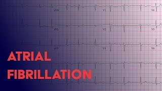 Atrial Fibrillation Afib  EKG ECG Interpretation [upl. by Melamie884]