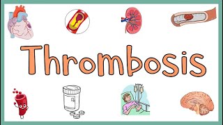 Thrombosis  Definition Causes Types Morphology Fate of a Thrombus amp Clinical manifestations [upl. by Onaicul]