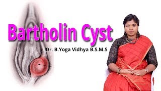 பார்தோலின் நீர்க்கட்டி  Bartholin Cyst Causes  Ethnic Health Care  Dr BYoga Vidhya 2018 [upl. by Nilac352]