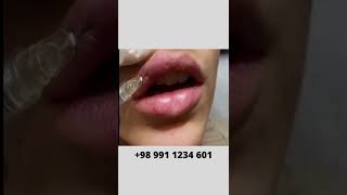 How to Fill In Your Lips  Lip Filler Injection [upl. by Stelu]