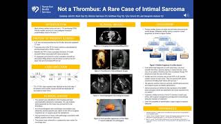 Not a Thrombus A Rare Case of Intimal Sarcoma [upl. by Healion]