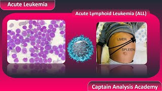 E2 Acute Lymphoblastic Leukemia ALL سرطان الدم الليمفاوى الحاد [upl. by Thin237]