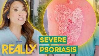 Dr Sandra Lee Treats Severe Psoriasis In 9YearOld Girl  Dr Pimple Popper Pop Ups [upl. by Amory]