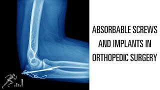 Absorbable screws and implants in orthopedic surgery [upl. by Iris]