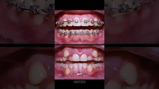 Así funcionan los brackets [upl. by Aicre]