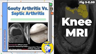 Fig 5E08 Acute Gouty Arthritis vs Septic Arthritis [upl. by Jemy857]