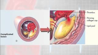 12 Lead Interpretation Part 61 Pathophysiolgoy of Myocardial Infarctions [upl. by Nanis]