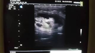 Gluteal Abscess Ultrasound [upl. by Elsey4]