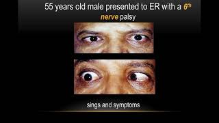 Neuroophthalmology approach to diplopia [upl. by Perren]