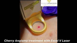 Cherry Angioma Treatment with Excel V Laser [upl. by Johst]