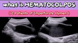 What is Hematocolpos Ultrasound  Imperforate Hymen  Blood in Vagina [upl. by Leake185]