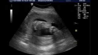 utrasound of baby boy at 28 weeks [upl. by Dlonyer632]