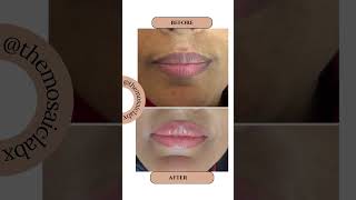 Lip neutralization done for pigmented lips [upl. by Phemia]