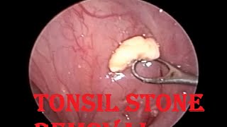 Tonsil Stone  Infected Cheesy Material Removal from Tonsillar Crypt [upl. by Schoenberg440]