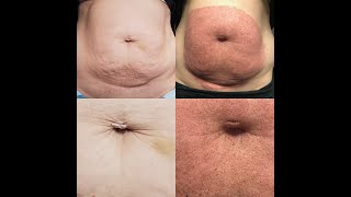 FIBROBLAST TREATMENT STOMACH BEFORE AND AFTER [upl. by Chaffinch694]