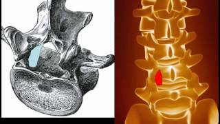 Behandlung der Spinalkanalstenose [upl. by Mayor952]