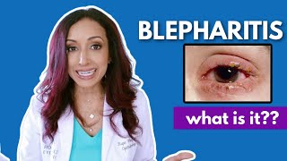 What Is Blepharitis Eye Doctor Explains [upl. by Graaf]