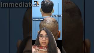 Overharvested Donor areas A disaster by unexperienced Hair Transplant Surgeons [upl. by Nanam]